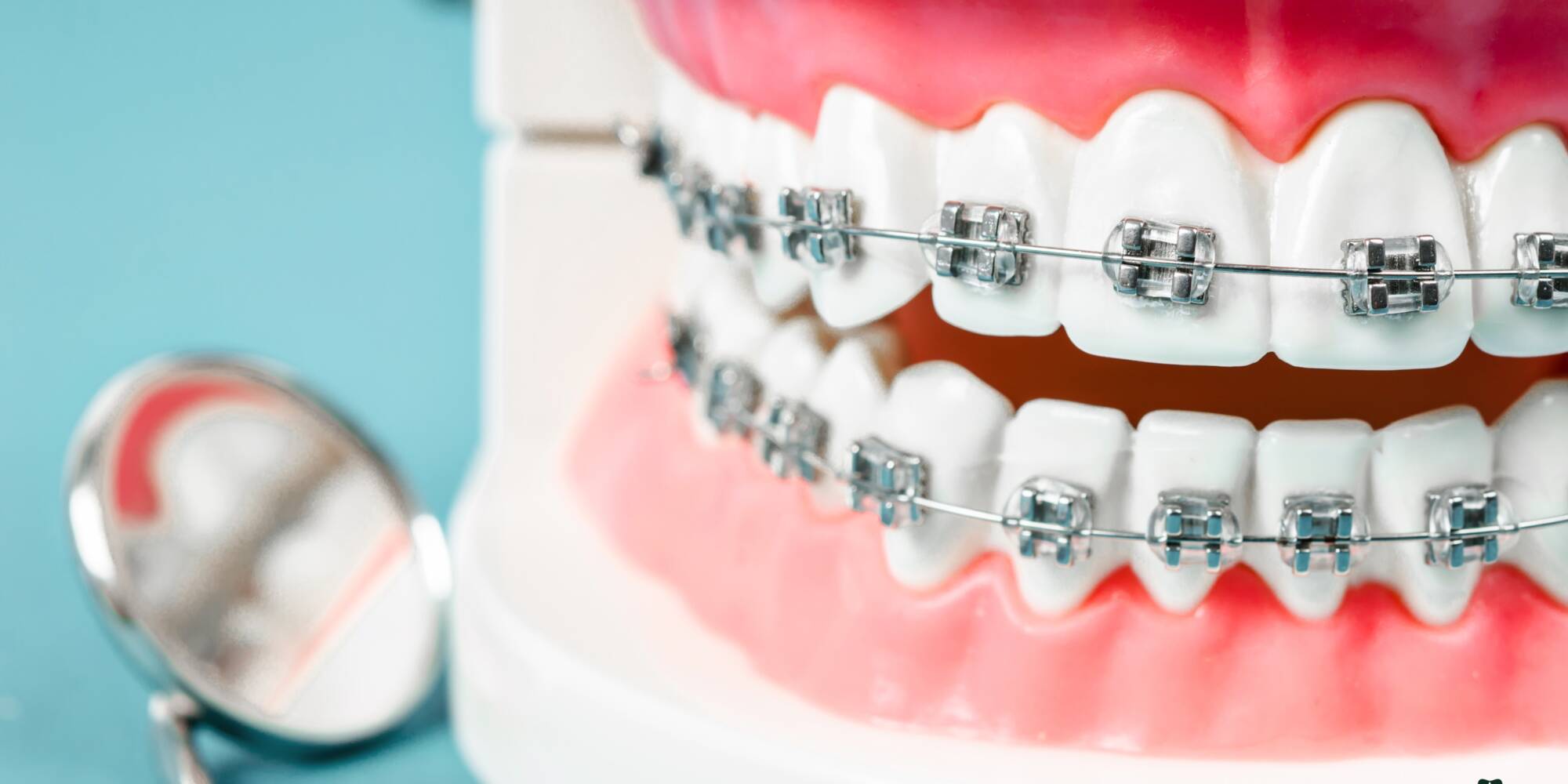 Dental Braces on Dental Model dental model with metal braces