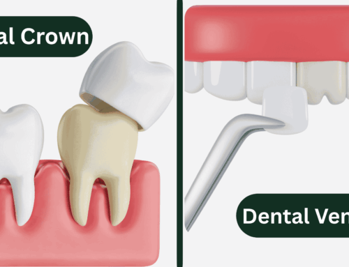 Crowns vs Veneers: Understanding the Key Differences