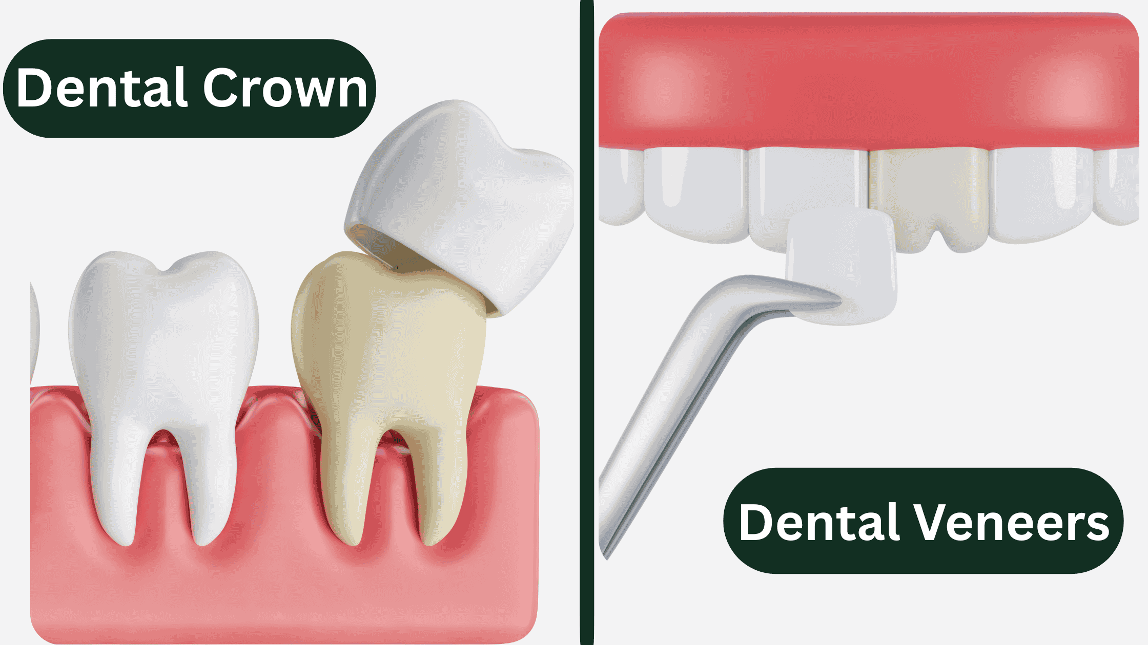 Side-by-side comparison of dental crowns and dental veneers showing their placement on teeth.