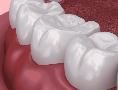 How Long Do Temporary Fillings Last?