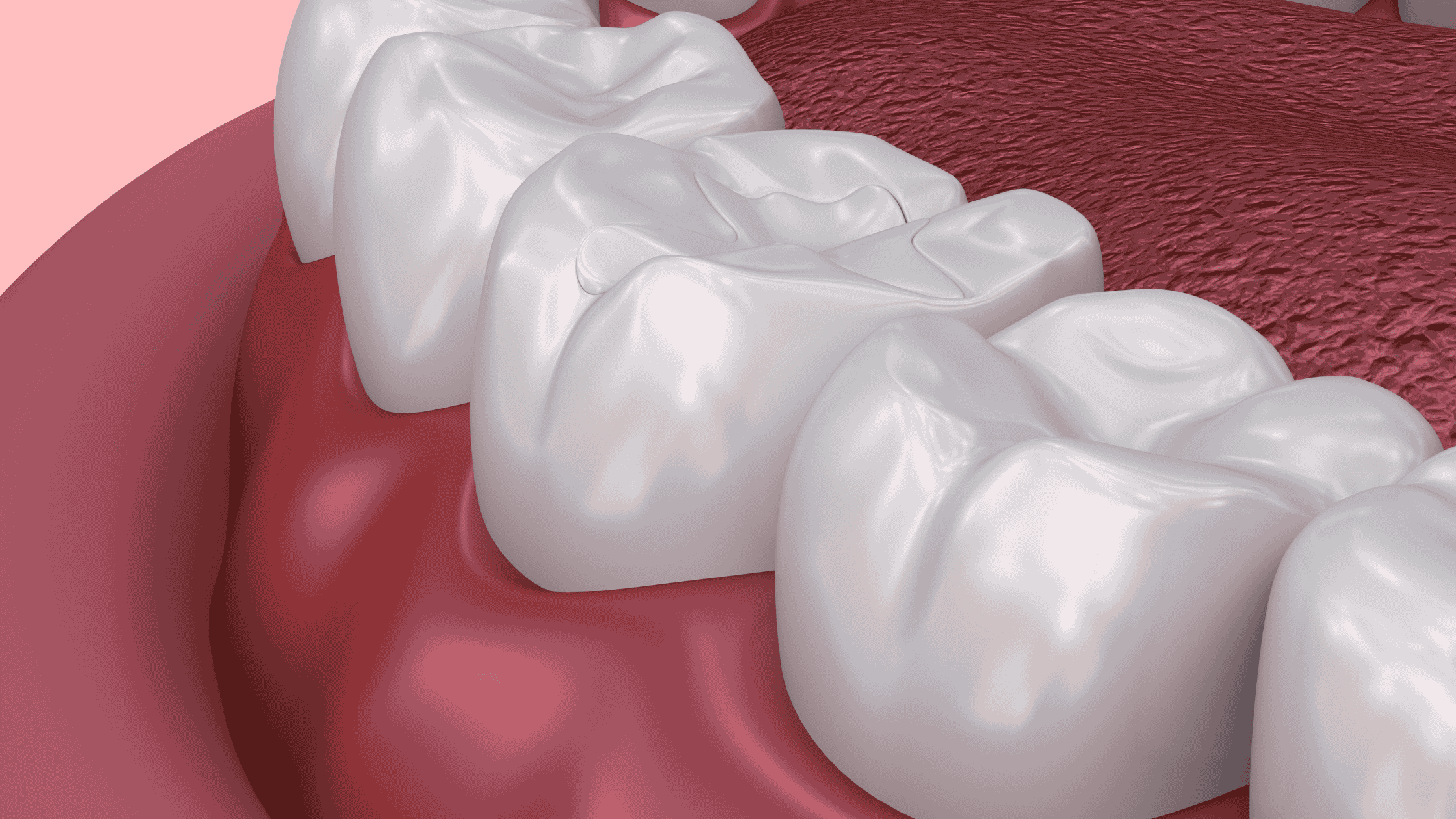 a picture showing a dental temporary fillings